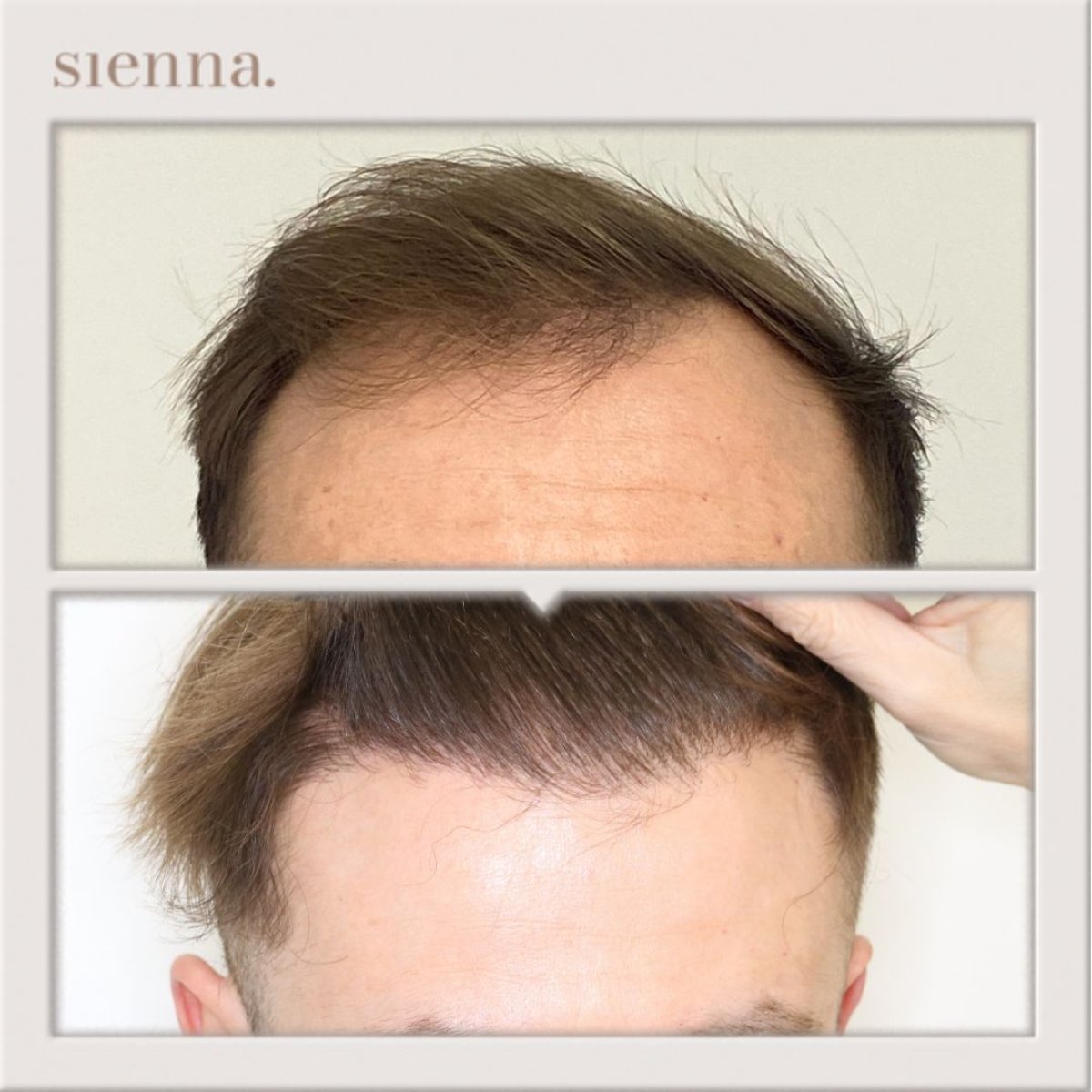 نتيجة زراعة الشعر FUE قبل وبعد في Sienna Clinic، خط شعر محسّن للرجال
