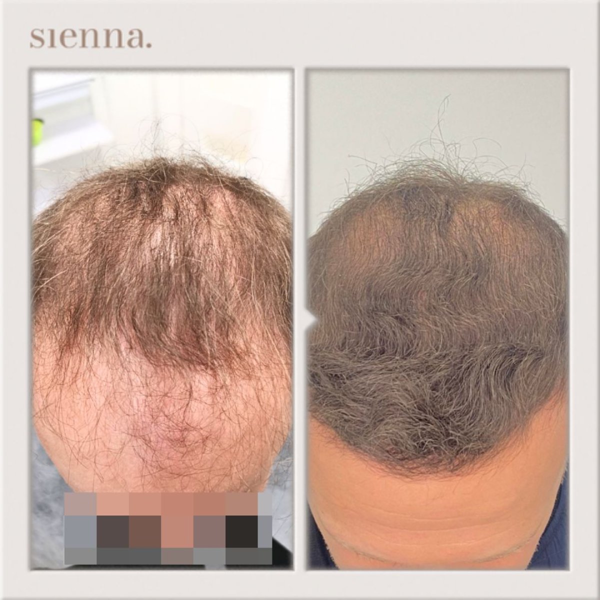 Before and after FUE hair transplant result at Sienna Clinic showing restored hair density