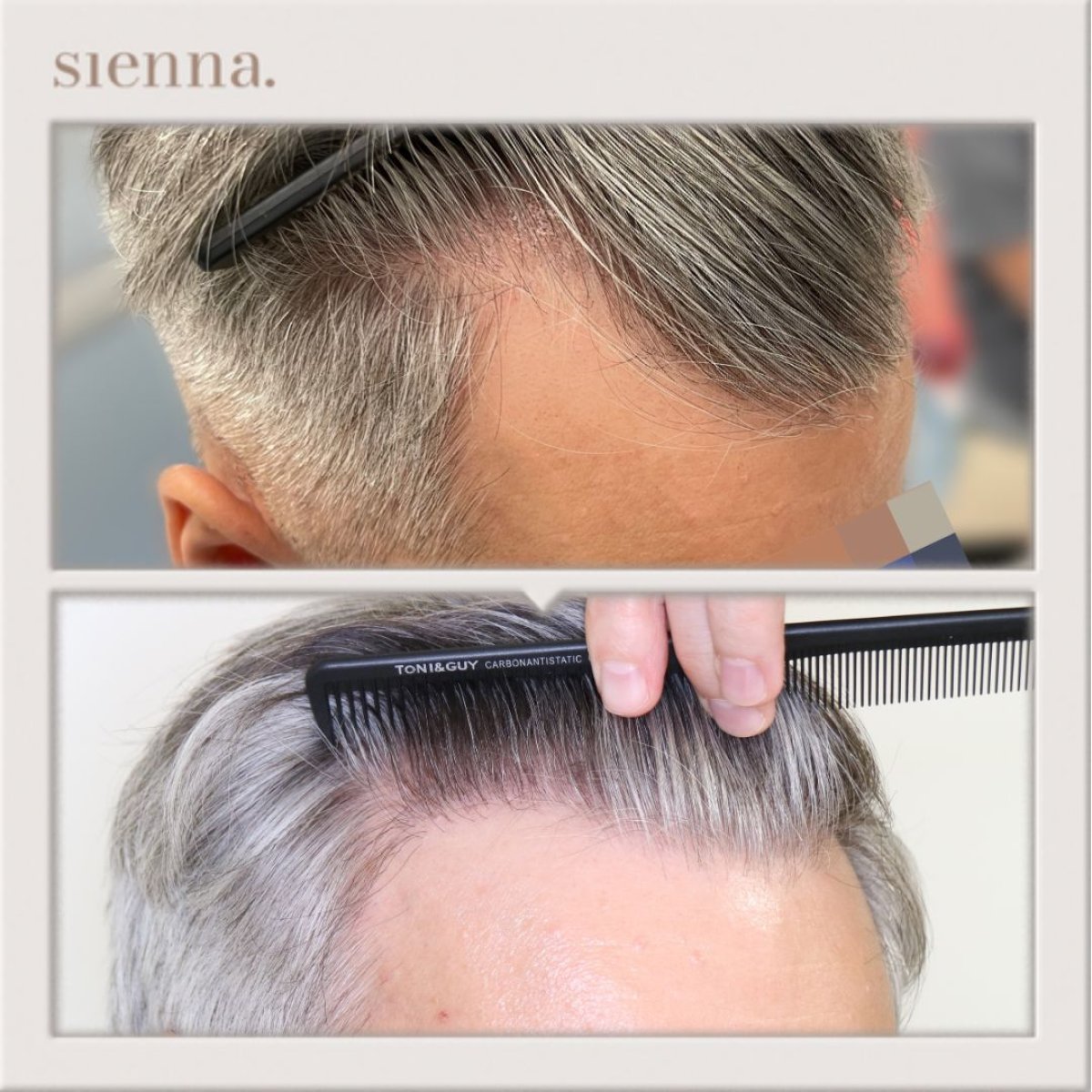 نتيجة زراعة الشعر FUE قبل وبعد في Sienna Clinic، استعادة خط الشعر الطبيعي