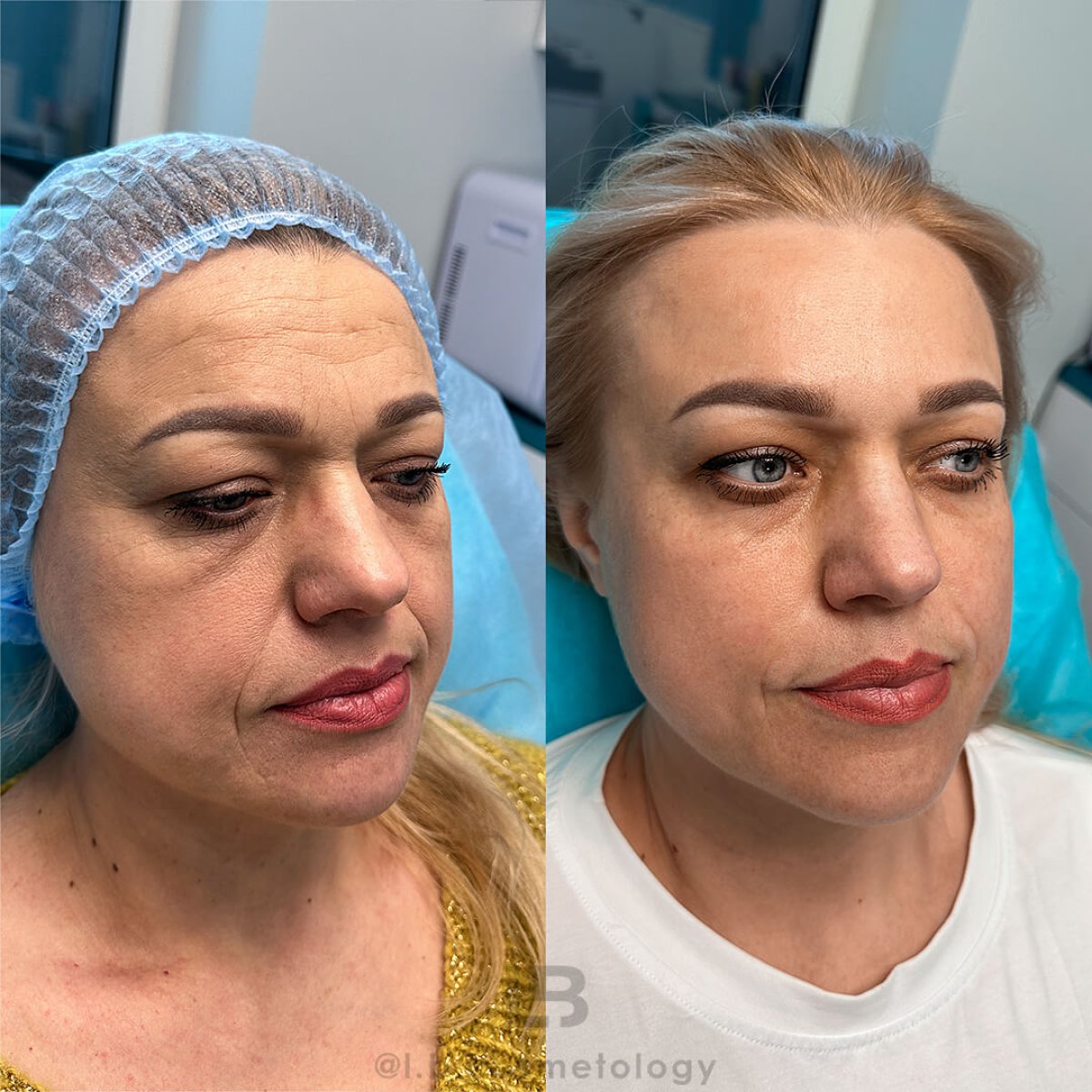 Resultados antes y después de lifting facial sin cirugía – rostro más liso y rejuvenecido