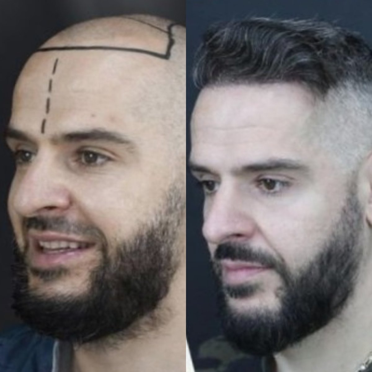Before and after DHI hair transplant result at Grand Clinic, restored natural hairline