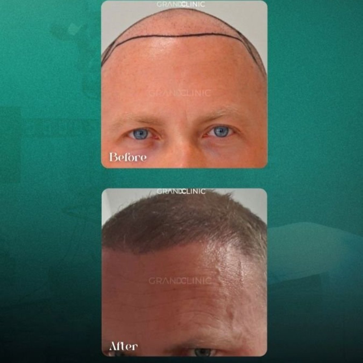 Before and after DHI hair transplant results at Grand Clinic – restored hairline in male patient