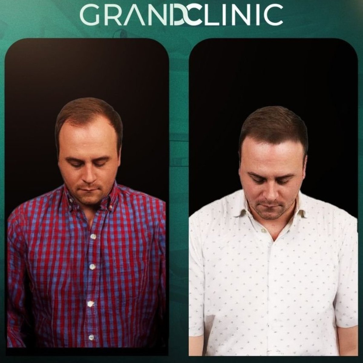 Resultados antes y después de trasplante capilar DHI en Grand Clinic, mayor densidad