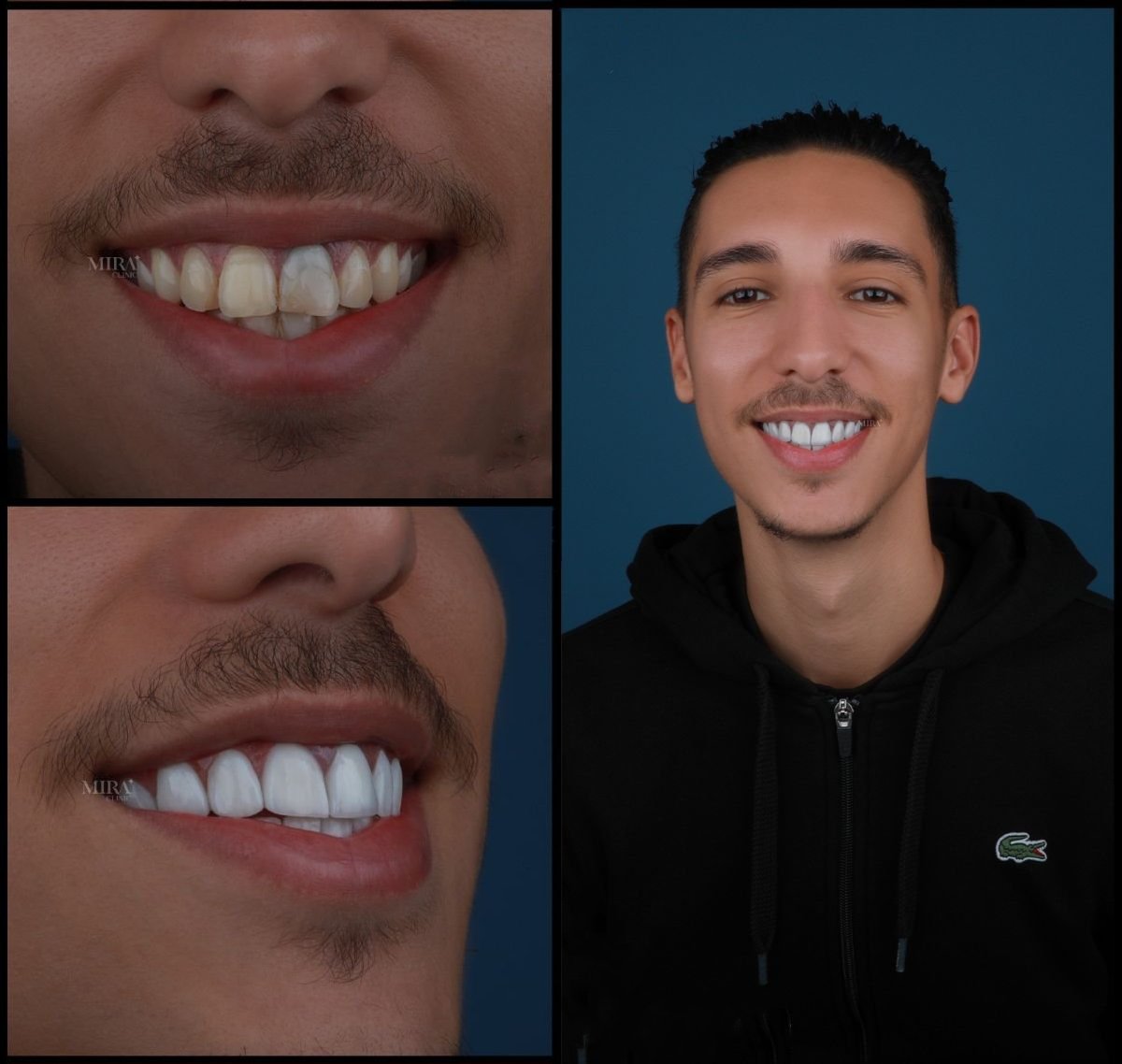 Resultado antes y después de carillas dentales en Mira Clinic, sonrisa mejorada y dientes blancos