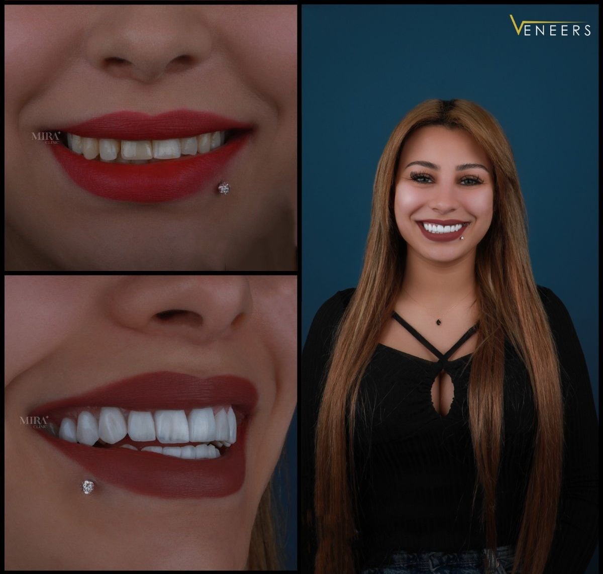 Resultado de carillas dentales antes y después en Mira Clinic, transformación de sonrisa