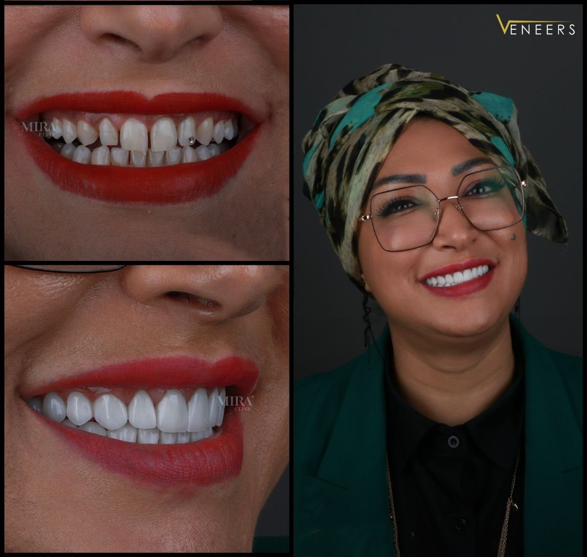 Resultados de carillas dentales antes y después en Mira Clinic, sonrisa blanca natural