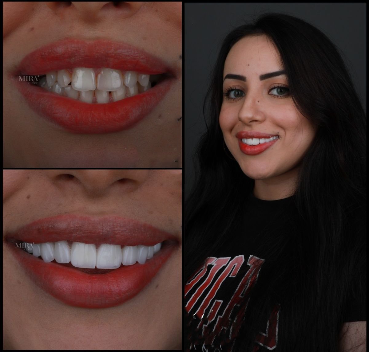 Before and after veneers result at Mira Clinic (Mira Clinic SAĞLIK TURİZM ŞİRKETİ), smile makeover