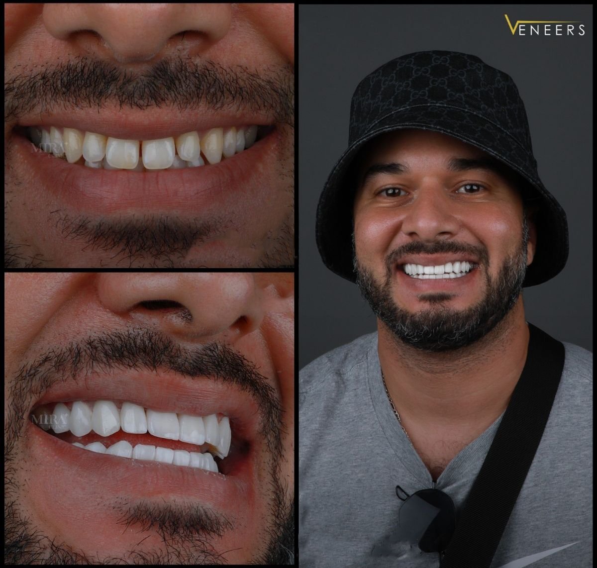Resultados de carillas dentales antes y después en Mira Clinic, sonrisa más blanca