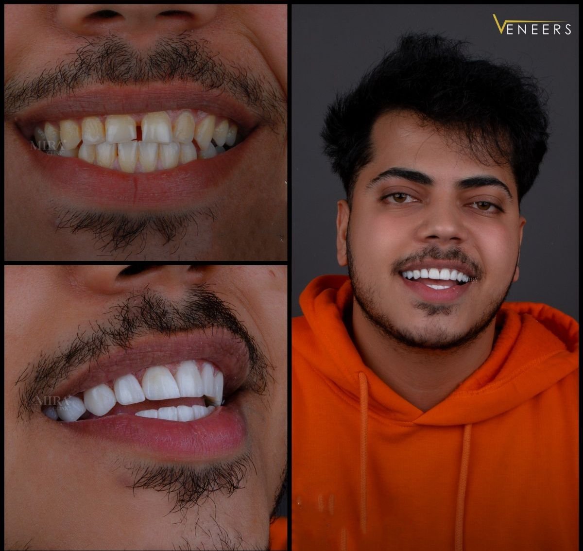 Resultados de carillas dentales antes y después en Mira Clinic, sonrisa más blanca y uniforme