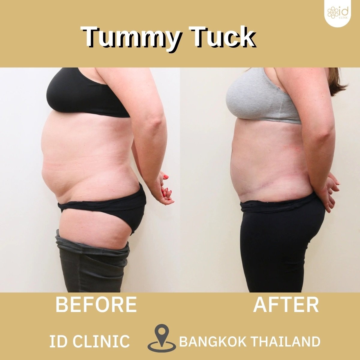 Résultats avant et après abdominoplastie à ID Clinic Bangkok – amélioration du contour abdominal