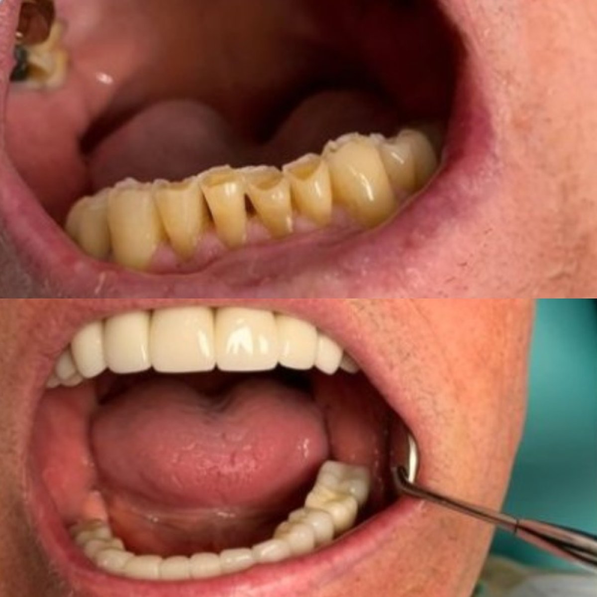 نتائج قبل وبعد تركيب تيجان الأسنان في CIVICO DENTAL CARE MEXICALI، استعادة الابتسامة