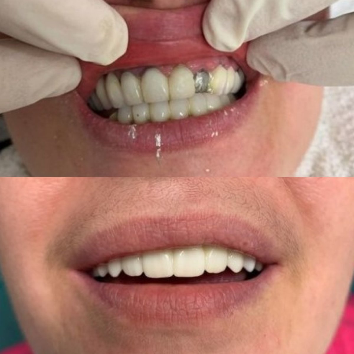 نتيجة قبل وبعد تركيب تيجان الأسنان في CIVICO DENTAL CARE MEXICALI، استعادة الابتسامة