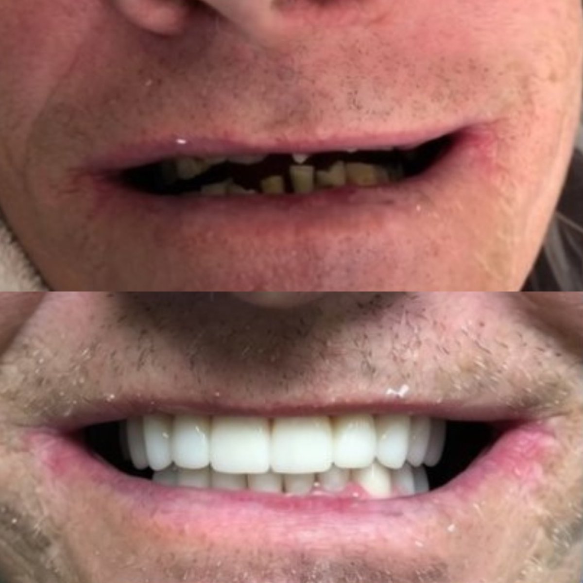 نتائج قبل وبعد تركيب تيجان الأسنان في CIVICO DENTAL CARE MEXICALI، ابتسامة مستعادة
