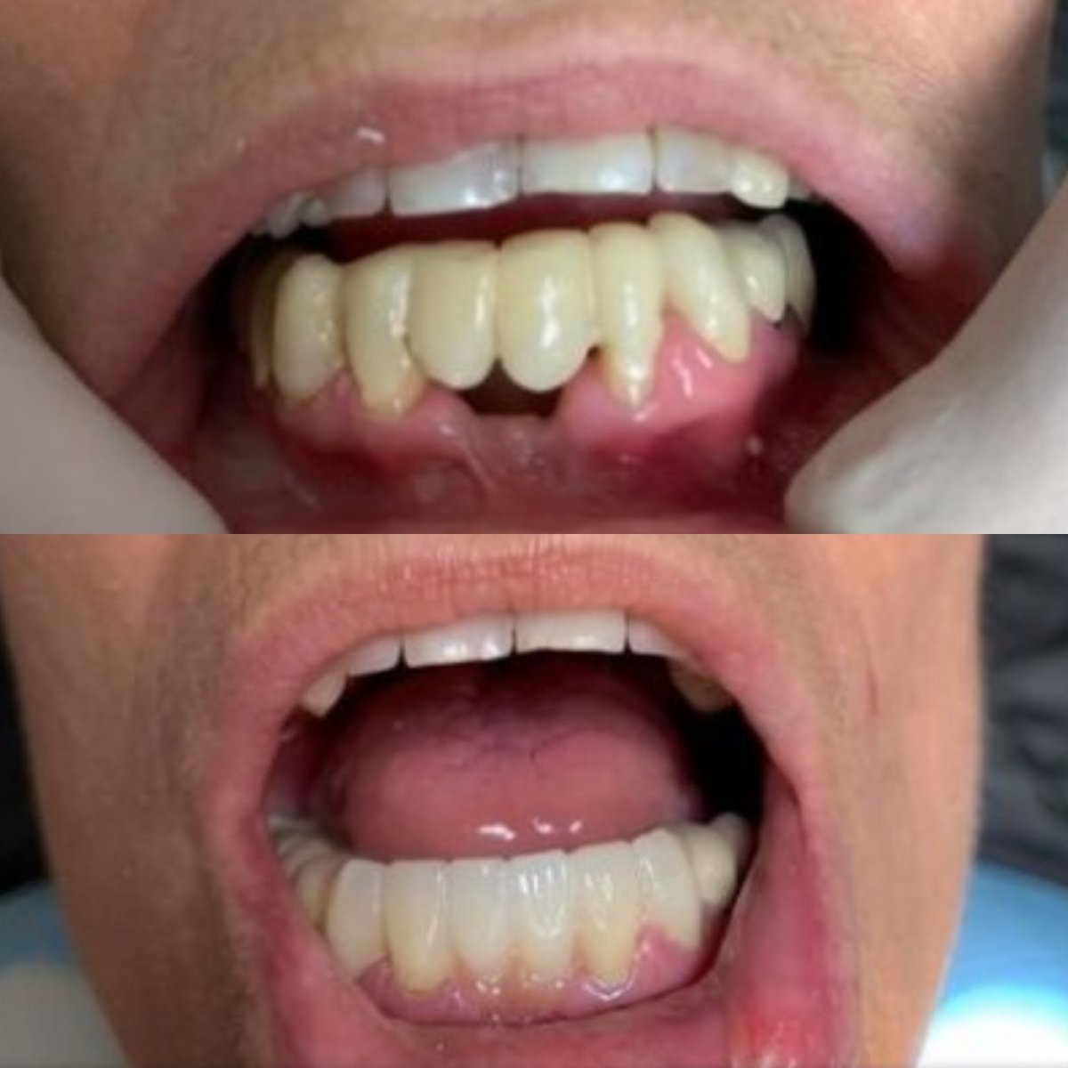 نتائج قبل وبعد تركيب تيجان الأسنان في CIVICO DENTAL CARE MEXICALI، ابتسامة محسنة