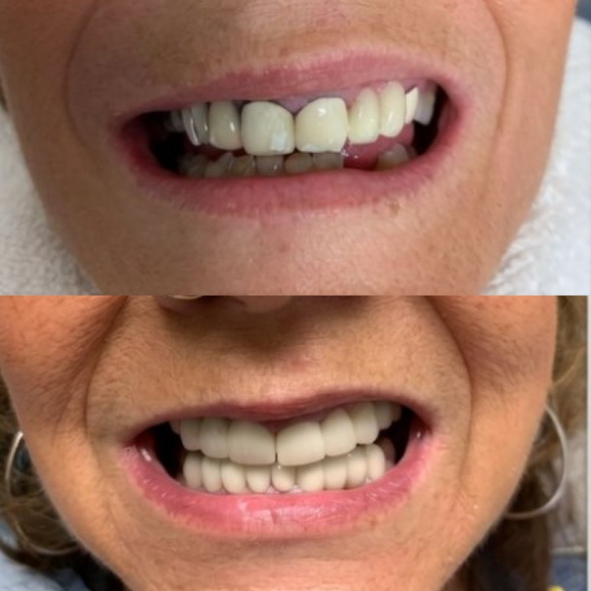 نتائج قبل وبعد تركيب تيجان الأسنان في CIVICO DENTAL CARE MEXICALI، استعادة الابتسامة