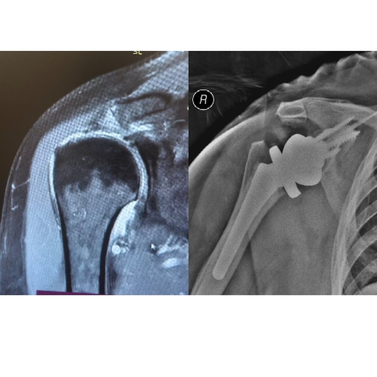 Before and after shoulder replacement results at Dr Andreas Papadopoulos Sports Medicine Clinic