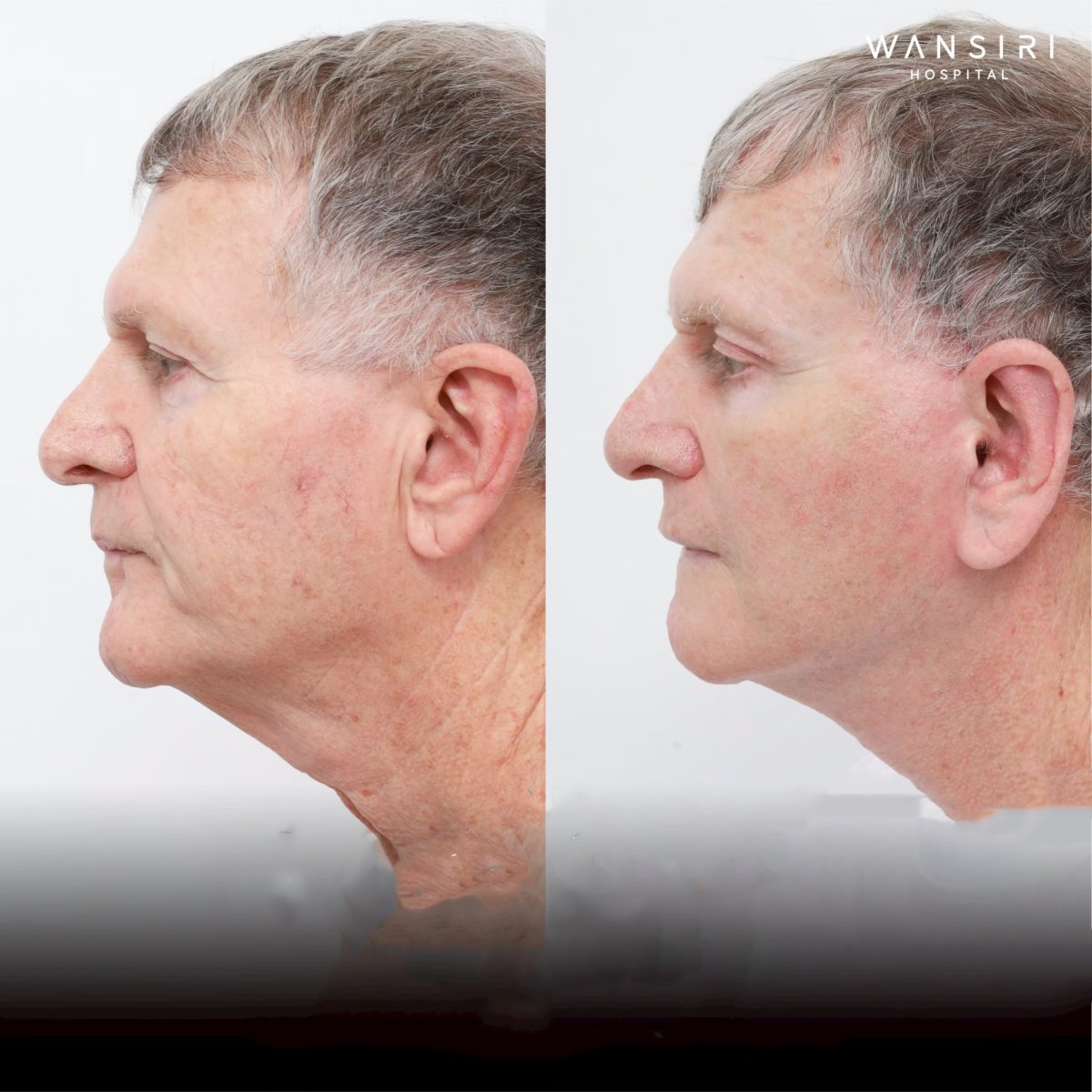 Resultado antes y después de deep plane facelift en Wansiri Hospital, lifting visible de cuello y mandíbula