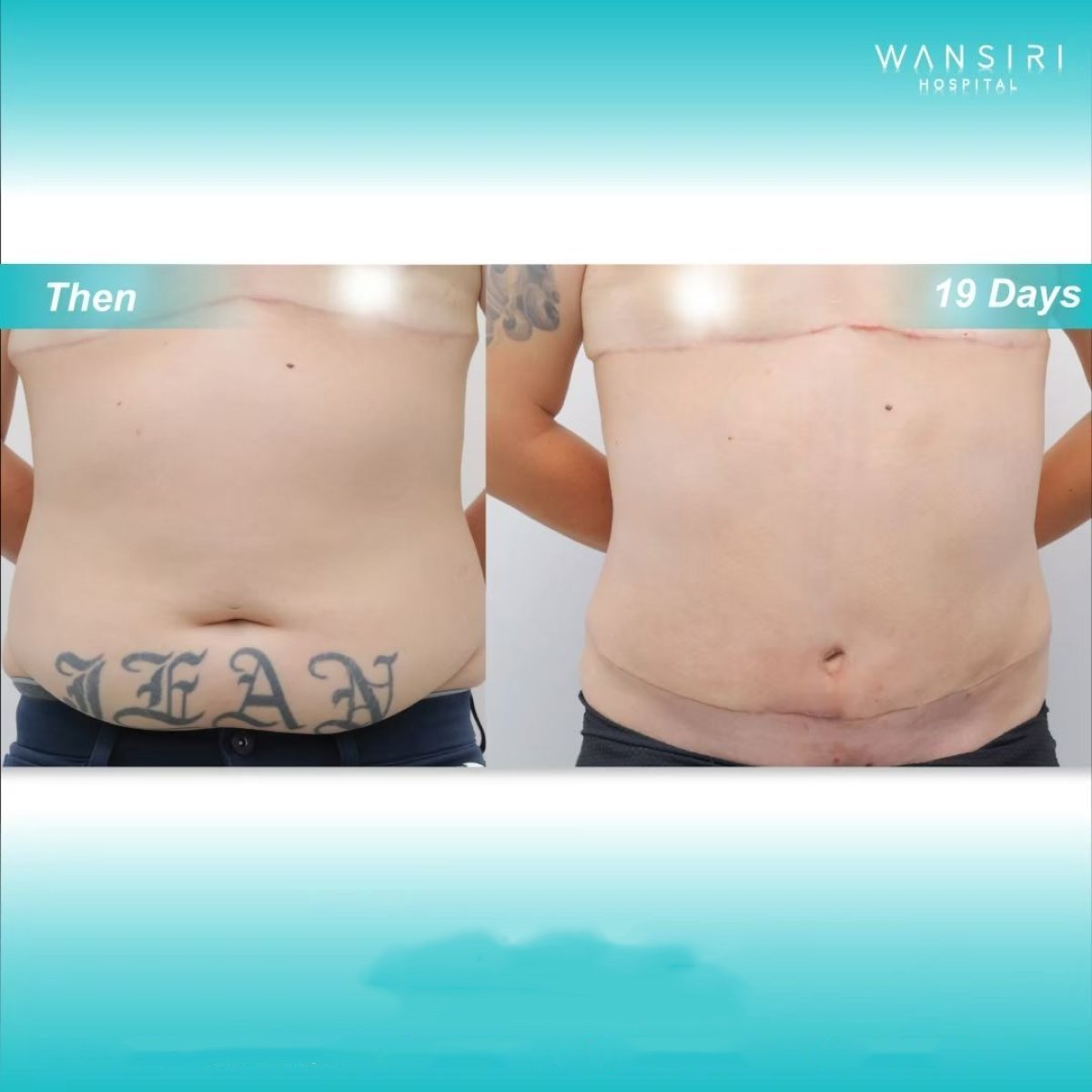 Before and after Vaser liposuction results at Wansiri Hospital, visible abdomen contouring