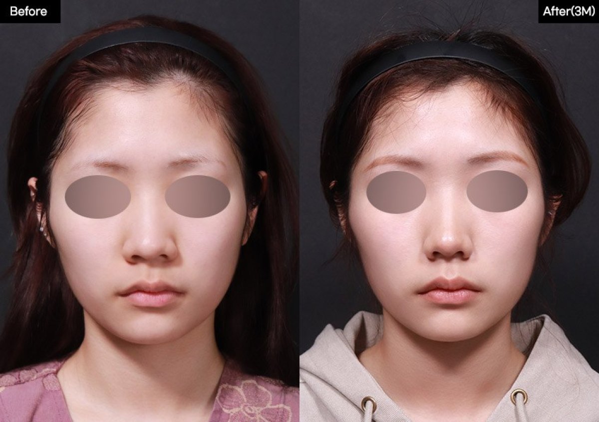 Результат до і після ринопластики кінчика носа у VG Plastic Surgery, покращена форма