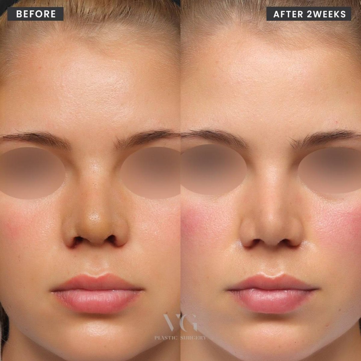 Before and after tip rhinoplasty results at VG Plastic Surgery, refined nose shape after 2 weeks