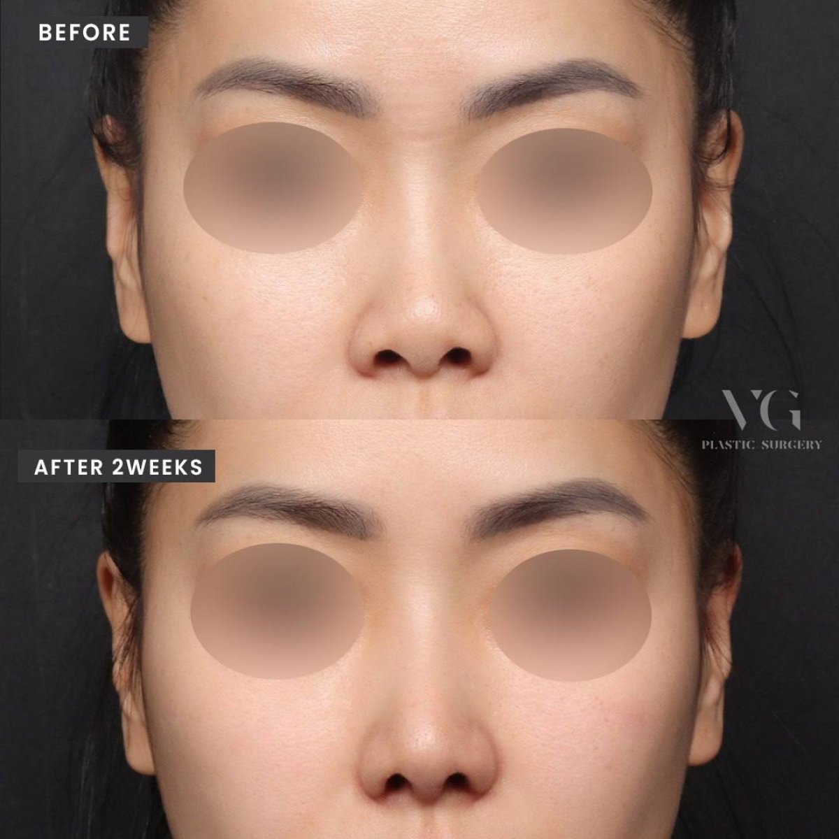 Résultats avant/après rhinoplastie de la pointe chez VG Plastic Surgery, affinement visible