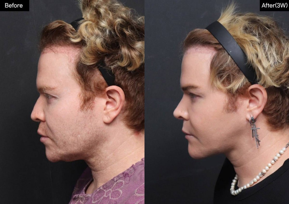 Résultat avant/après rhinoplastie de la pointe chez VG Plastic Surgery, pointe affinée