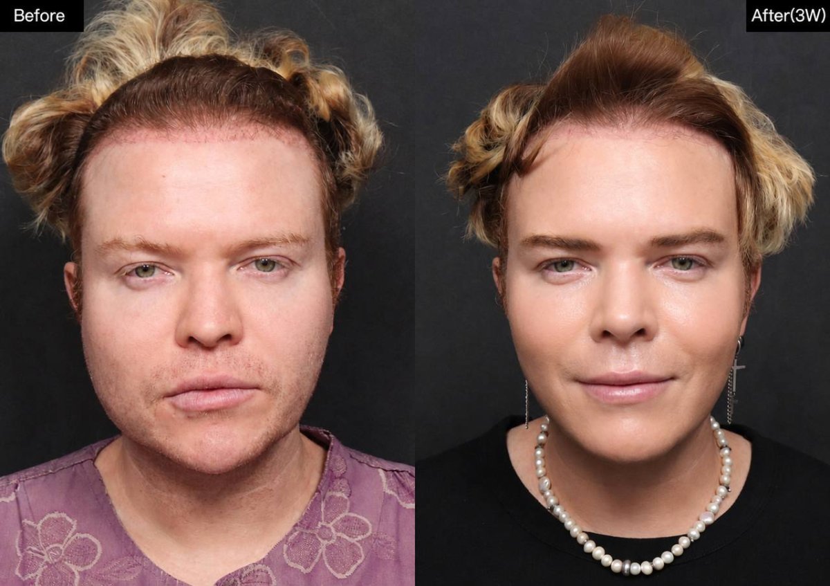 نتائج قبل وبعد تجميل طرف الأنف في VG Plastic Surgery، تحسين شكل الأنف وتحديده