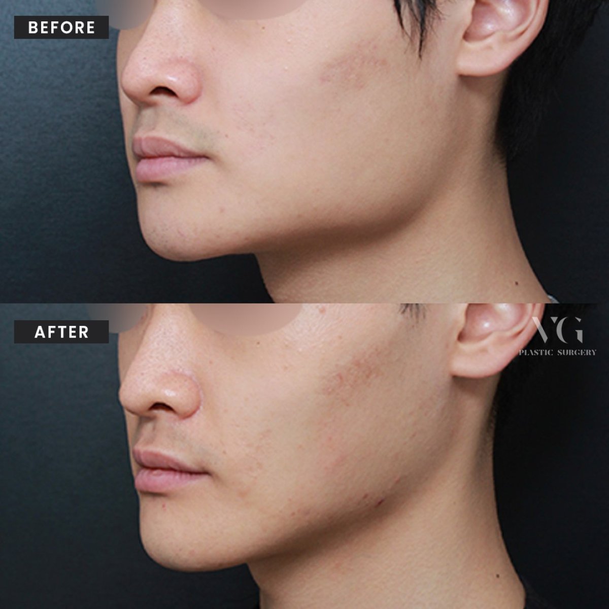 Результат ринопластики кончика носа до и после в VG Plastic Surgery, улучшен профиль носа