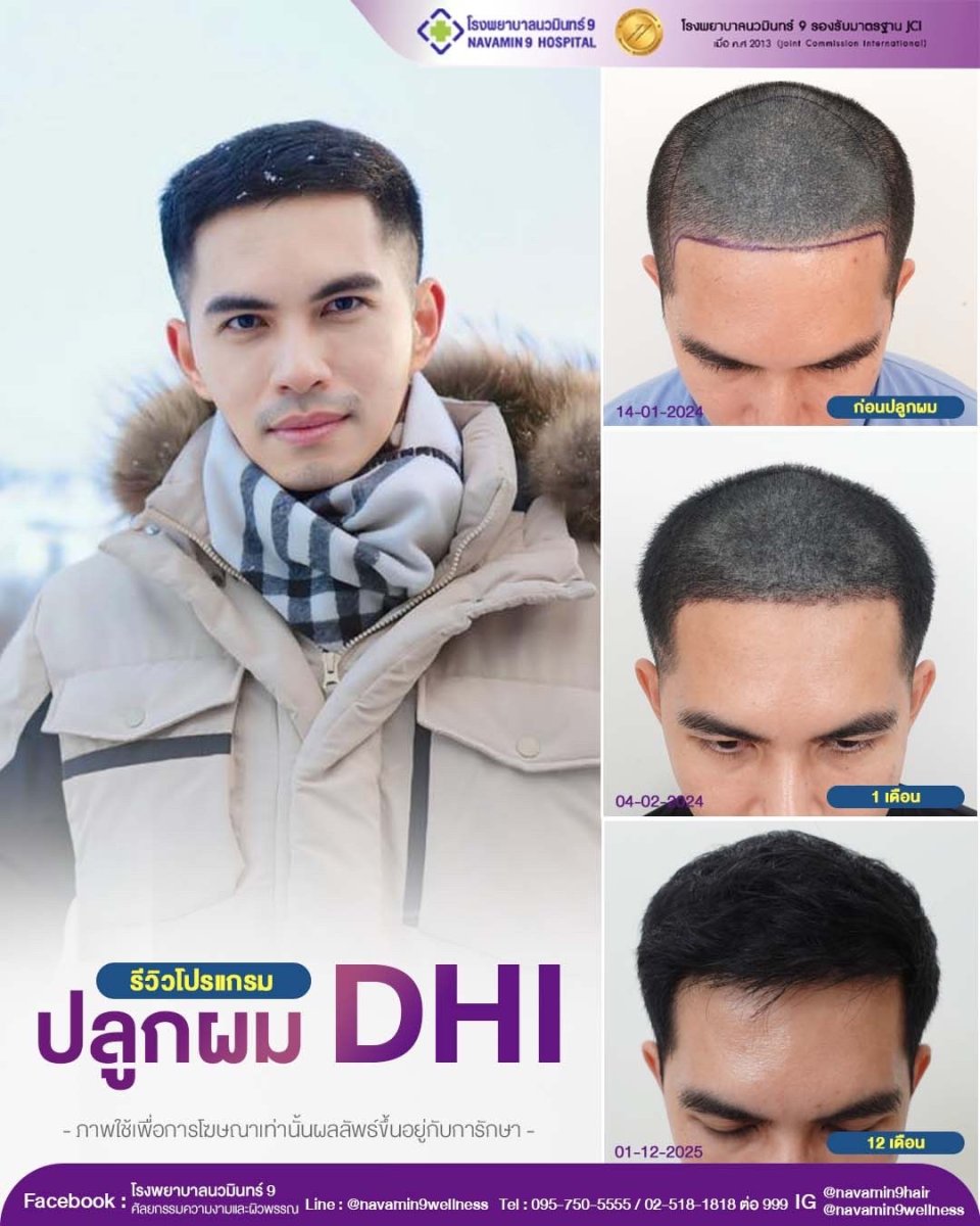 نتائج زراعة الشعر DHI قبل وبعد في قسم الجلد والجراحة - مستشفى NAVAMIN9