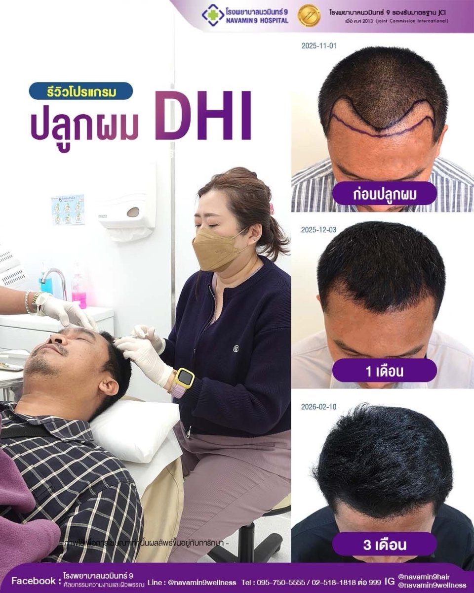 DHI hair transplant before and after results at Department of Skin & Surgery - NAVAMIN9 HOSPITAL