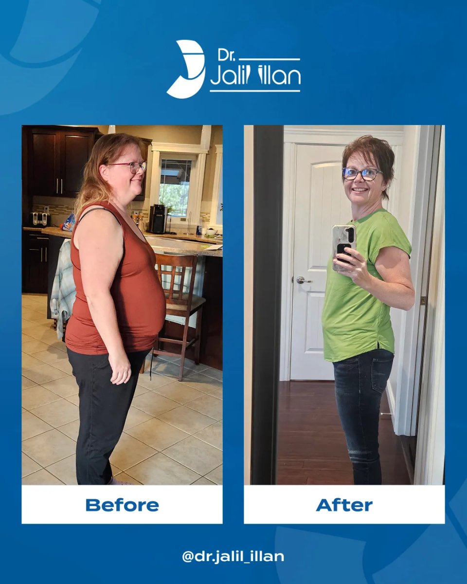Before and after tummy tuck results by Dr. Jalil Illan – visible abdominal contour improvement