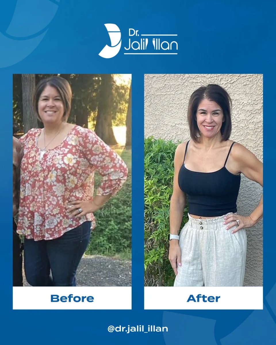 Résultats avant/après abdominoplastie chez Dr. Jalil Illan – amélioration du contour corporel