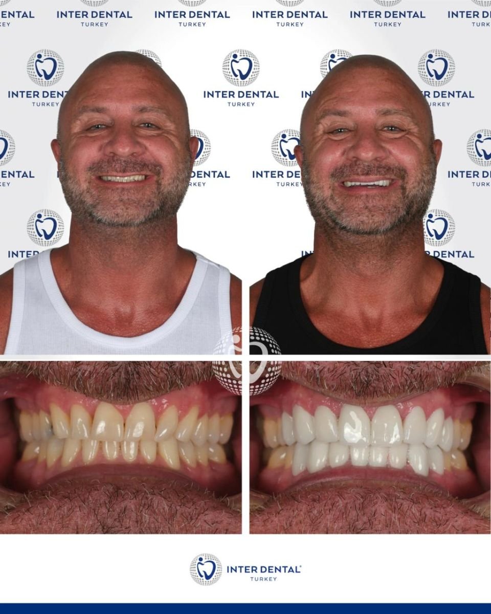Before and after Emax veneers at Inter Dental Turkey – smile makeover and whiter teeth result