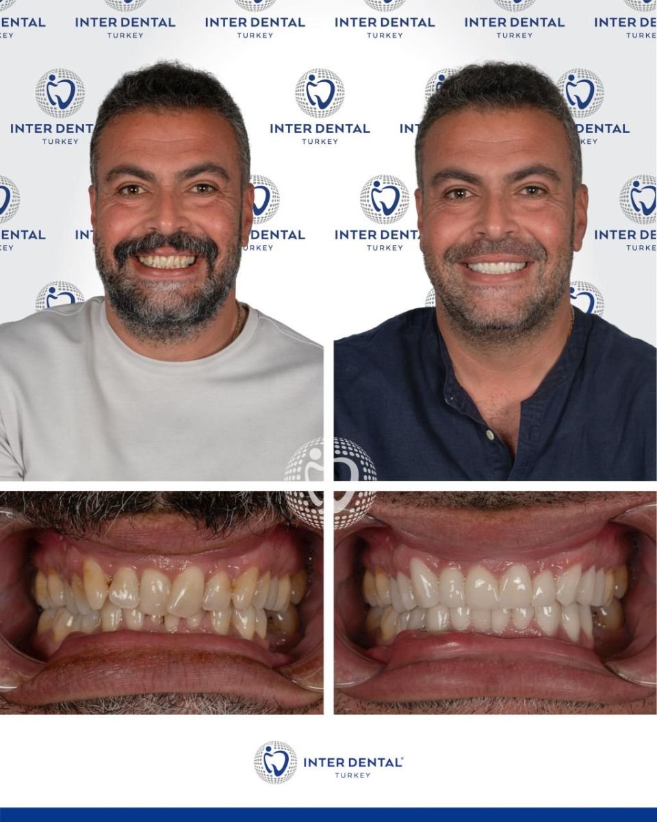 Before and after Emax veneers at Inter Dental Turkey – smile makeover and whiter teeth result