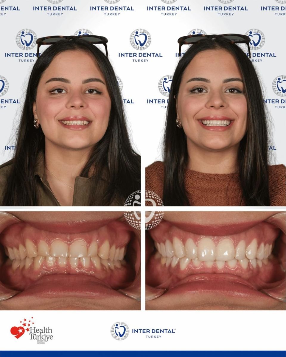 Before and after Emax veneers result at Inter Dental Turkey – improved smile aesthetics