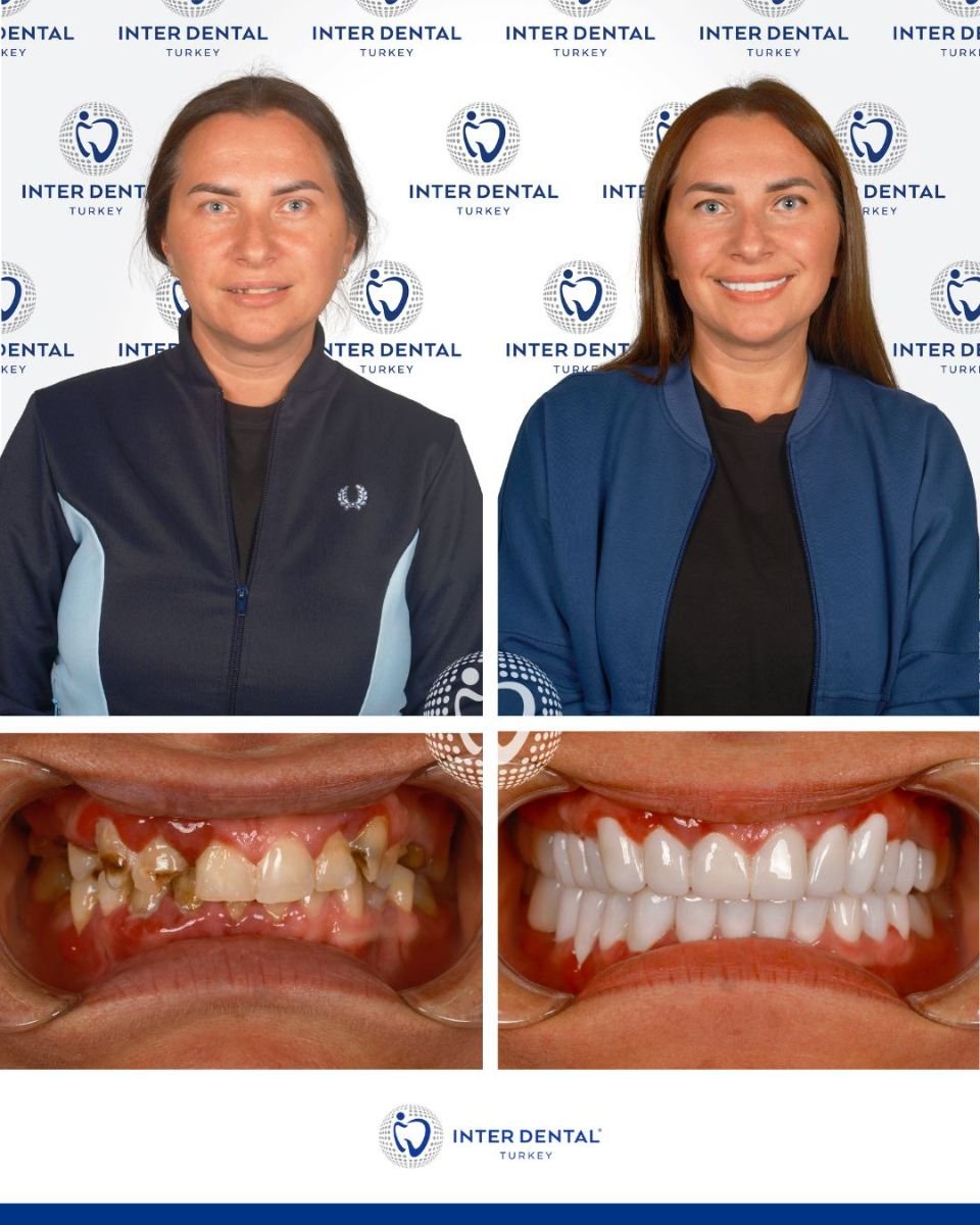 Efekty przed i po założeniu koron w Inter Dental Turkey, metamorfoza uśmiechu