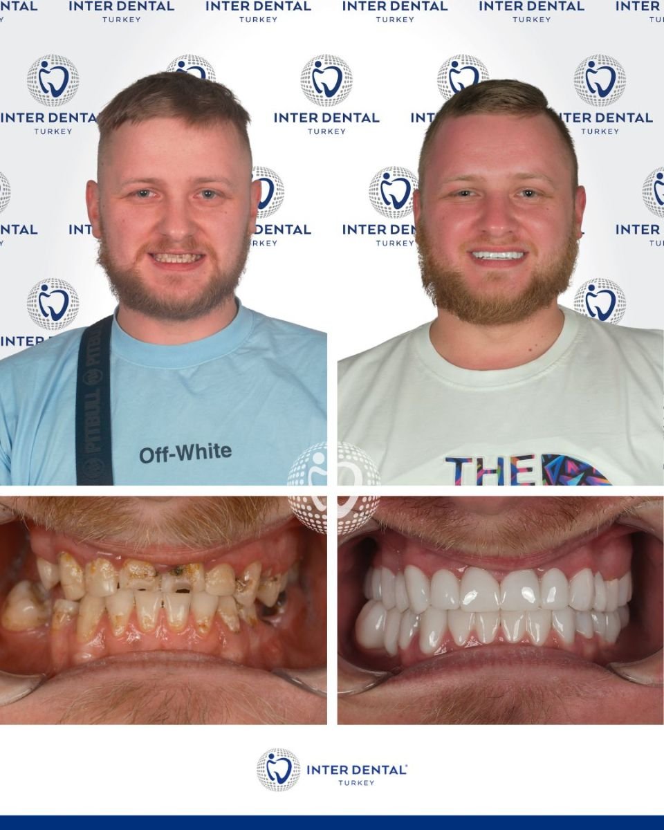 До и после установки зубных коронок в Inter Dental Turkey, результат преображения улыбки
