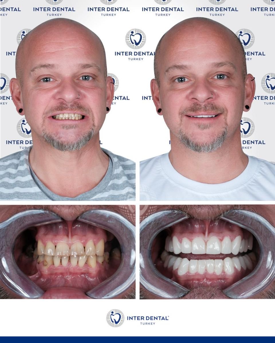 Antes y después de coronas dentales en Inter Dental Turkey, sonrisa natural lograda