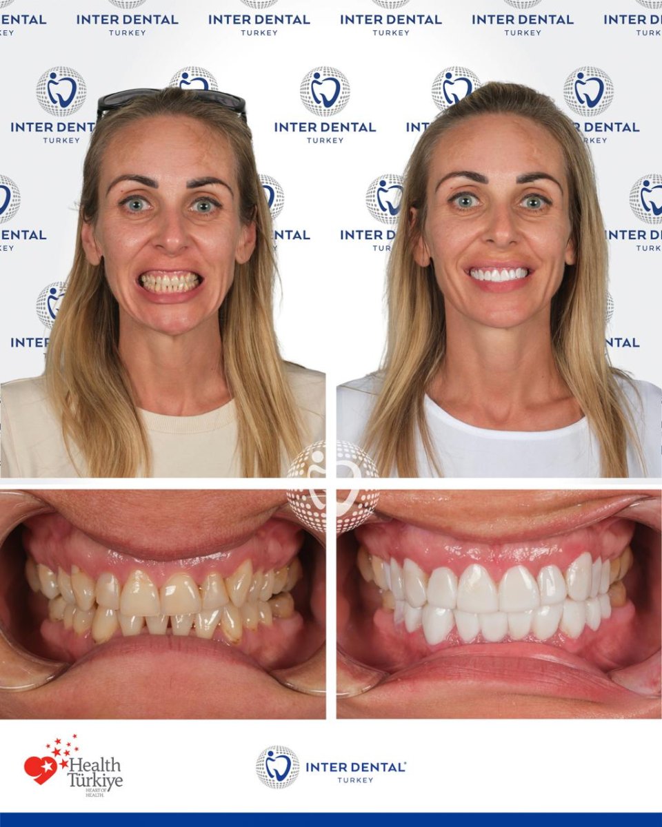 Before and after dental bonding results at Inter Dental Turkey, improved smile and whiter teeth