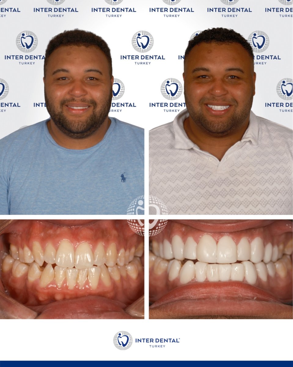 Before and after dental bonding results at Inter Dental Turkey – improved smile and whiter teeth