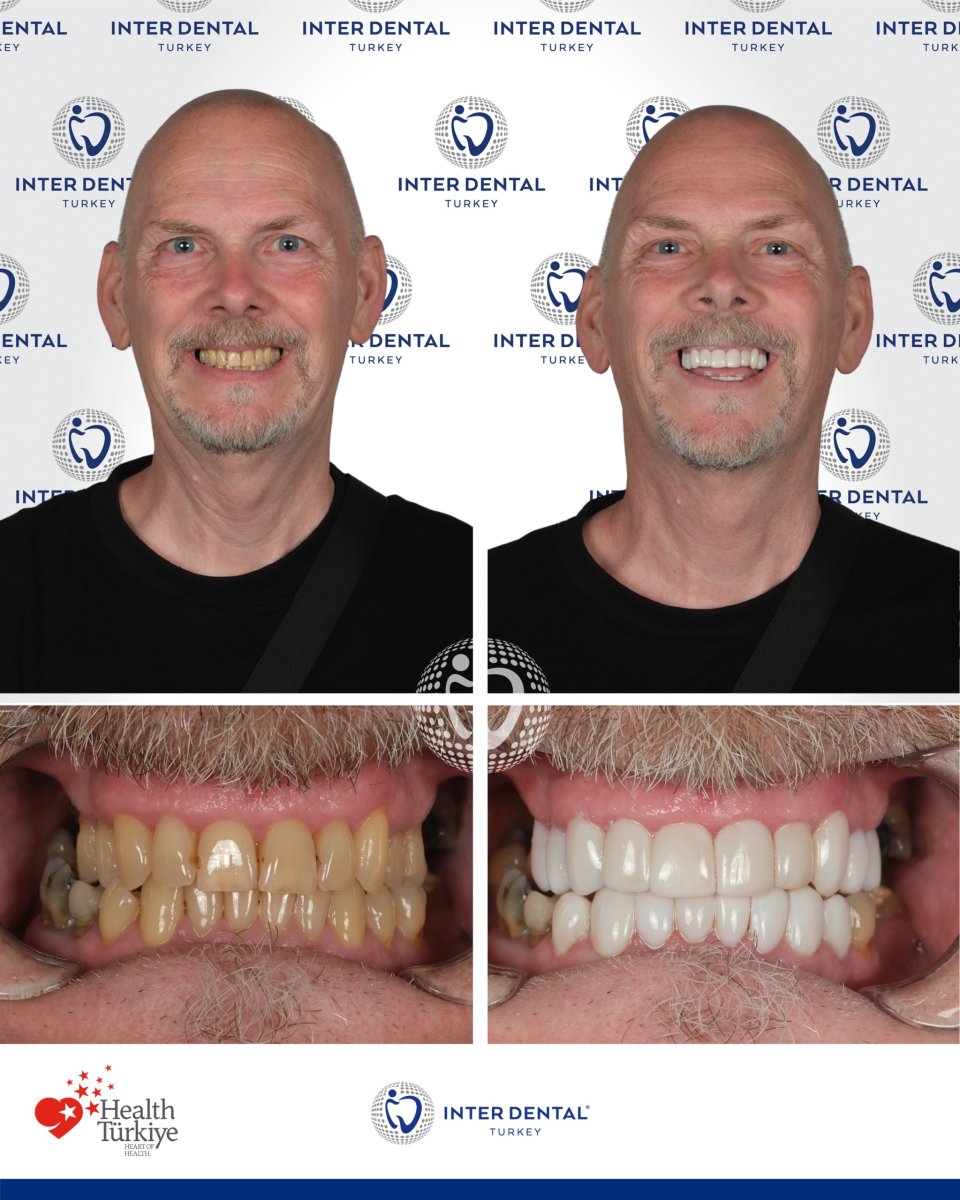 Before and after dental bonding results at Inter Dental Turkey – improved smile and whiter teeth