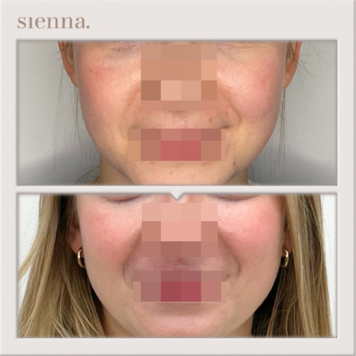 Before and after buccal fat extraction at Sienna Clinic, slimmer cheeks visible result