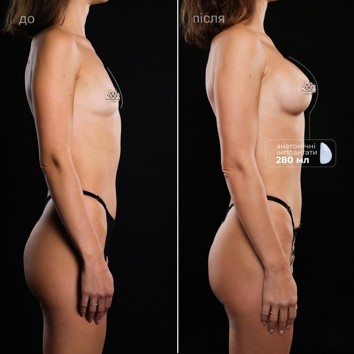 Résultat avant/après augmentation mammaire à la Vidnova Clinic avec implants anatomiques 280 ml