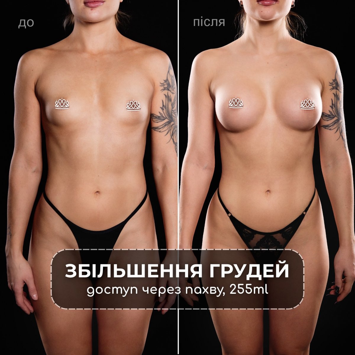 Résultats avant/après augmentation mammaire à Vidnova Clinic, implants axillaires 255ml