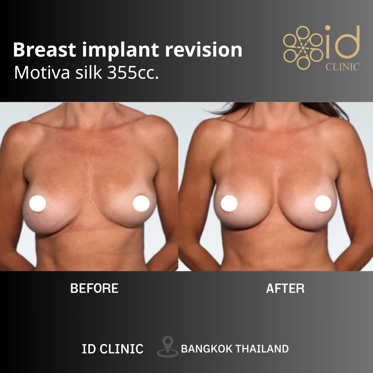 Before and after breast implant revision with Motiva 355cc at ID Clinic Bangkok results