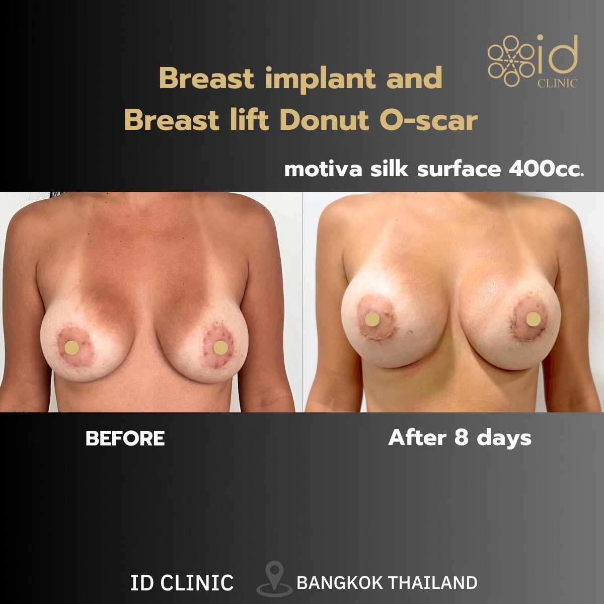 Antes y después de mastopexia con implantes redondos en ID Clinic Bangkok, resultado a 8 días