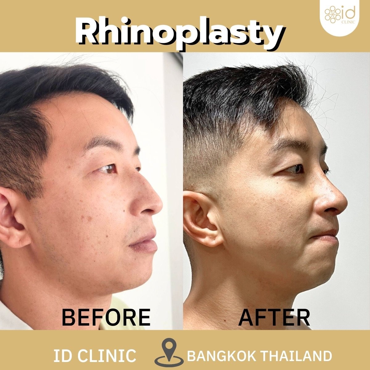 Vorher-nachher-Ergebnis der Spitzenrhinoplastik bei ID Clinic Bangkok, verbesserte Nasenform