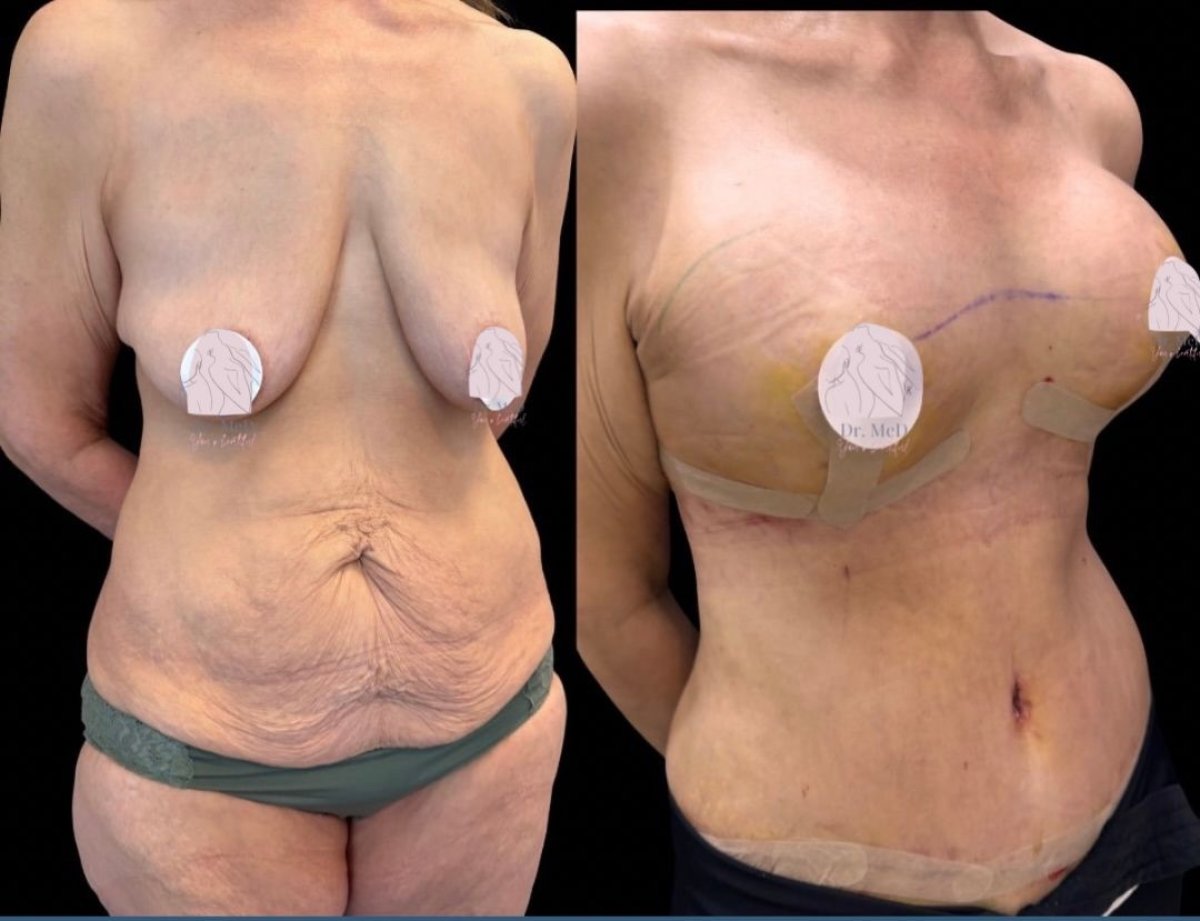 Before and after breast implant revision and tummy tuck results at Dr. MED clinic
