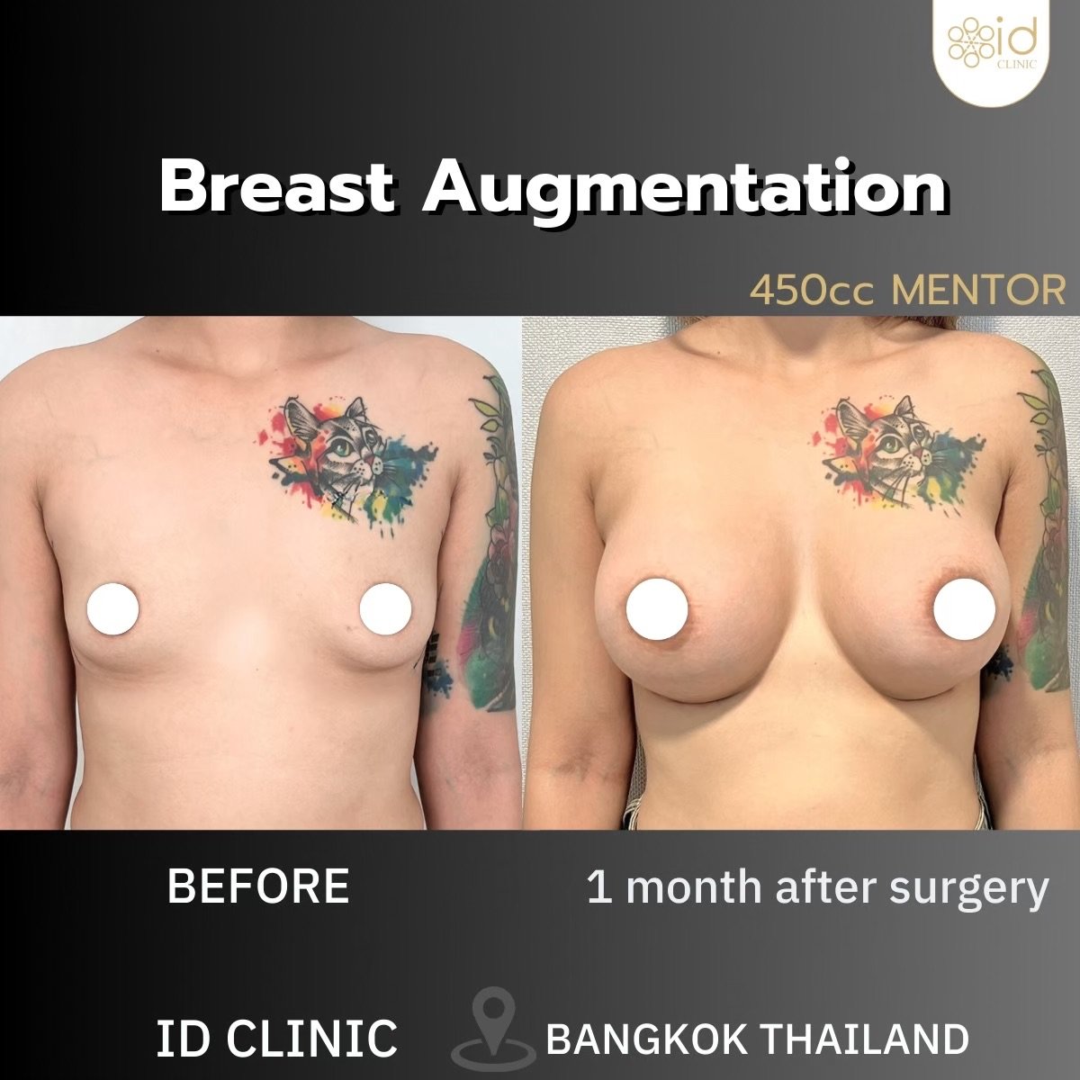 Before and after breast augmentation results at ID Clinic Bangkok, 450cc implants, 1 month post-op
