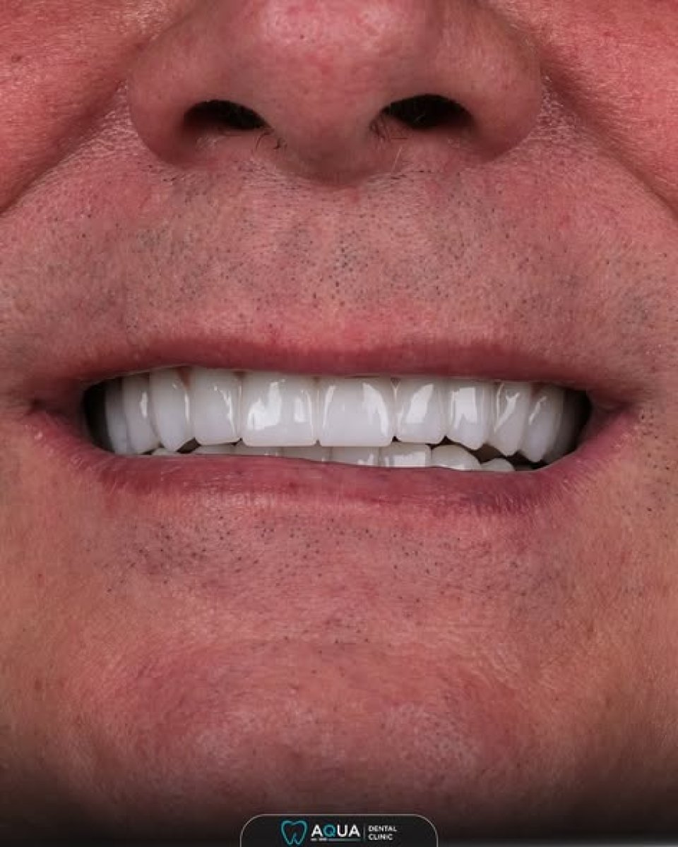 Ergebnis Zahnimplantat bei Aqua Dental Clinic – natürlich wirkendes Lächeln nach Behandlung